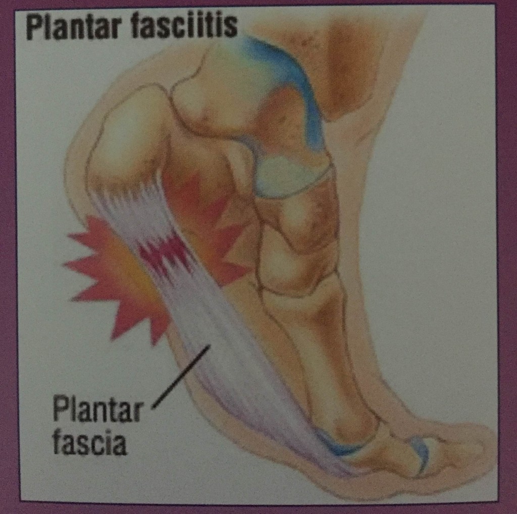 Peyton Manning Bad Plantar Fasciitis Vs Partial Tear Fenton Foot Care