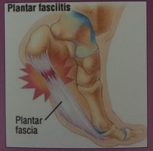 left plantar fascia